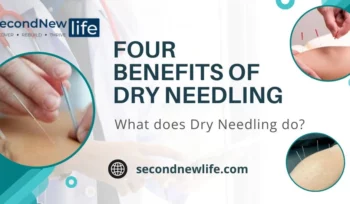 Benefits of Dry Needling Image