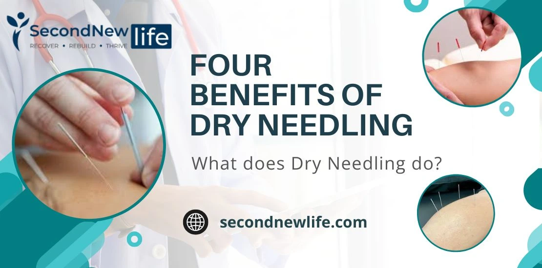Benefits of Dry Needling Image